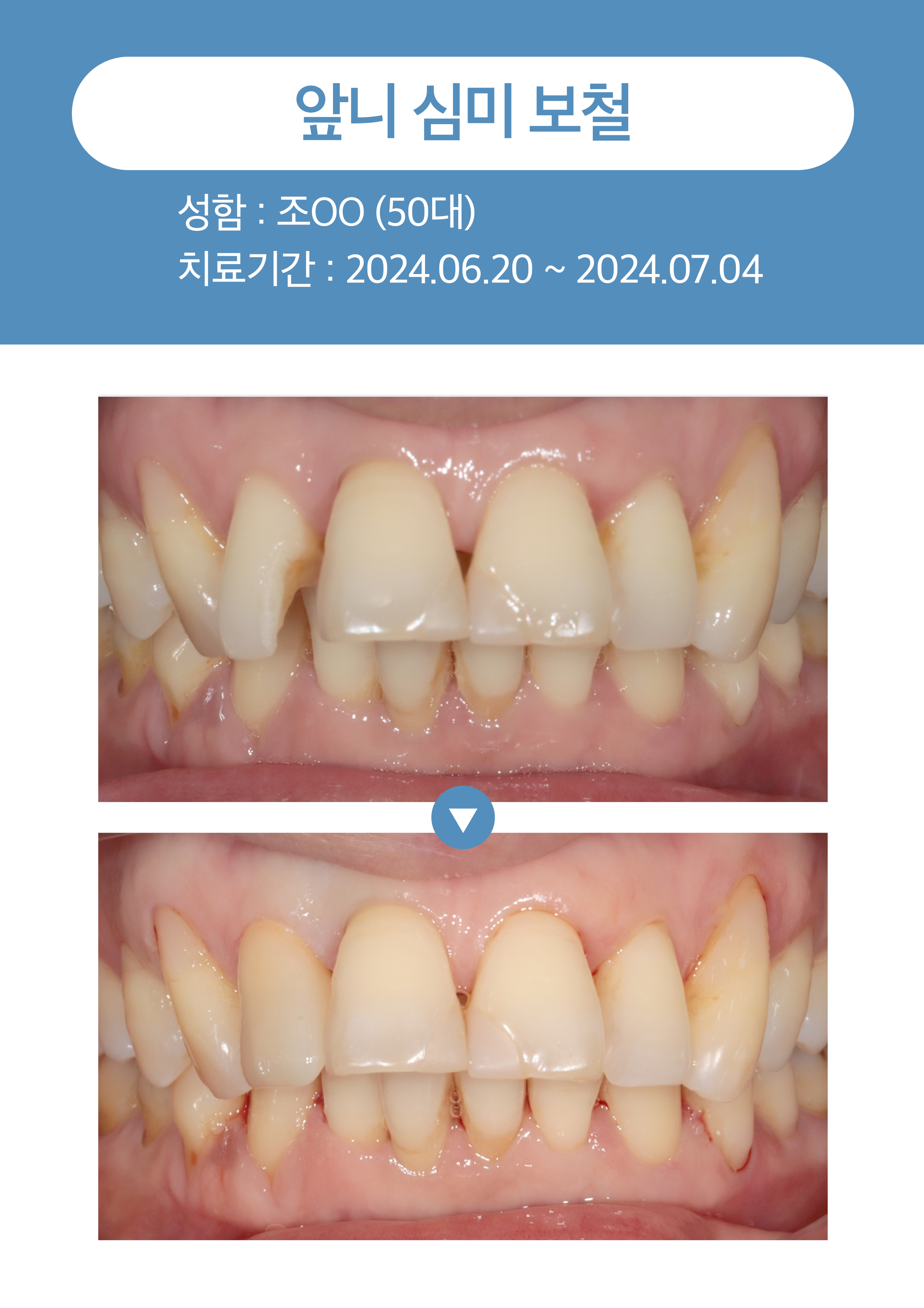 앞니 심미보철3