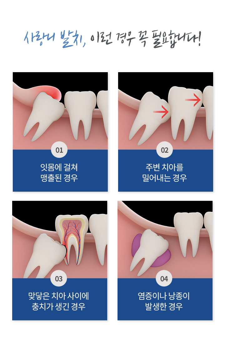 사랑니 발치, 이런 경우 꼭 필요합니다!