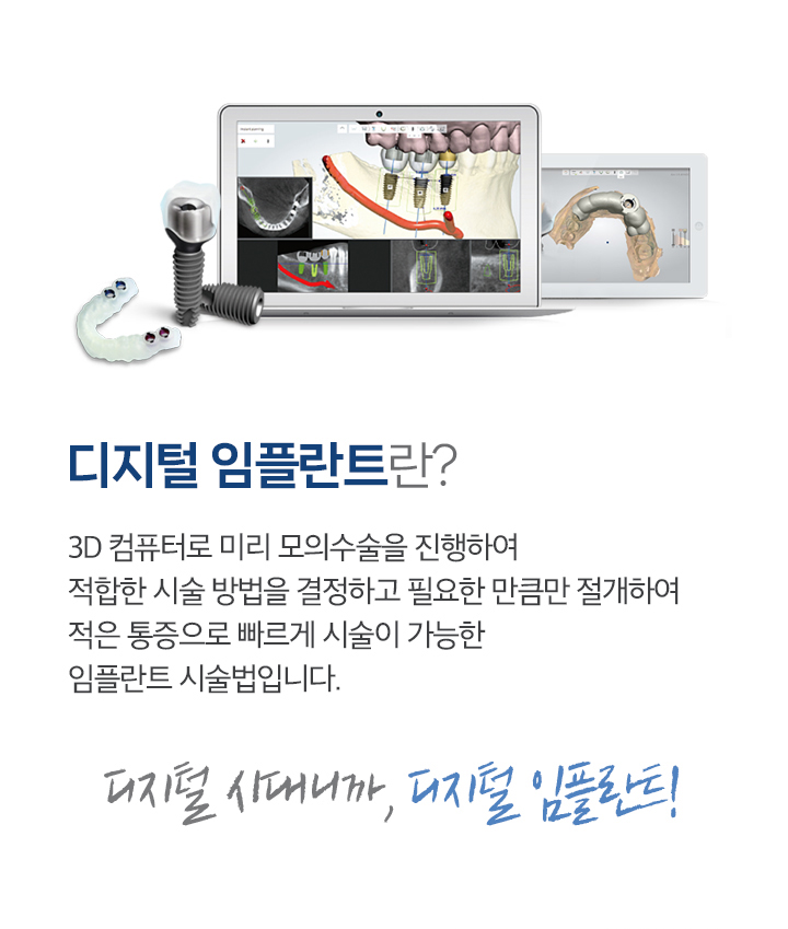 디지털 임플란트란?