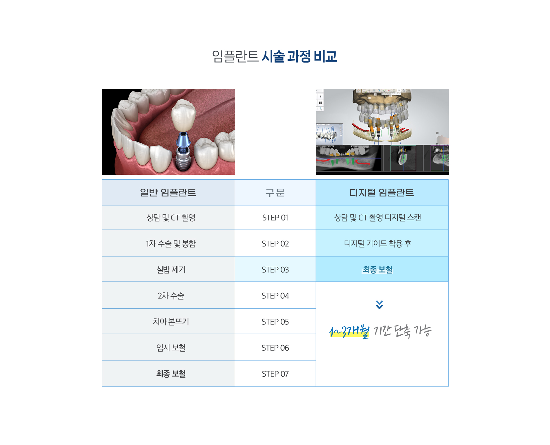 임플란트 시술 과정 비교