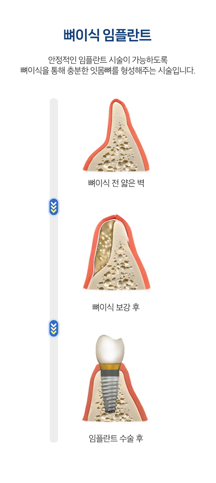 뼈이식 임플란트