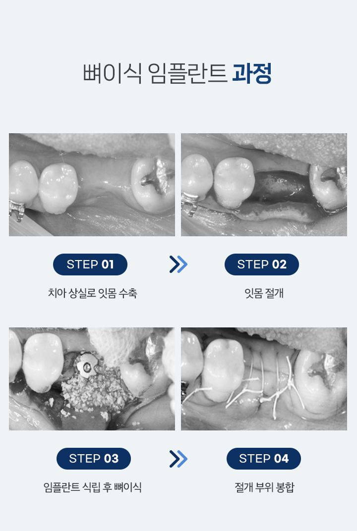 뼈이식 임플란트 과정