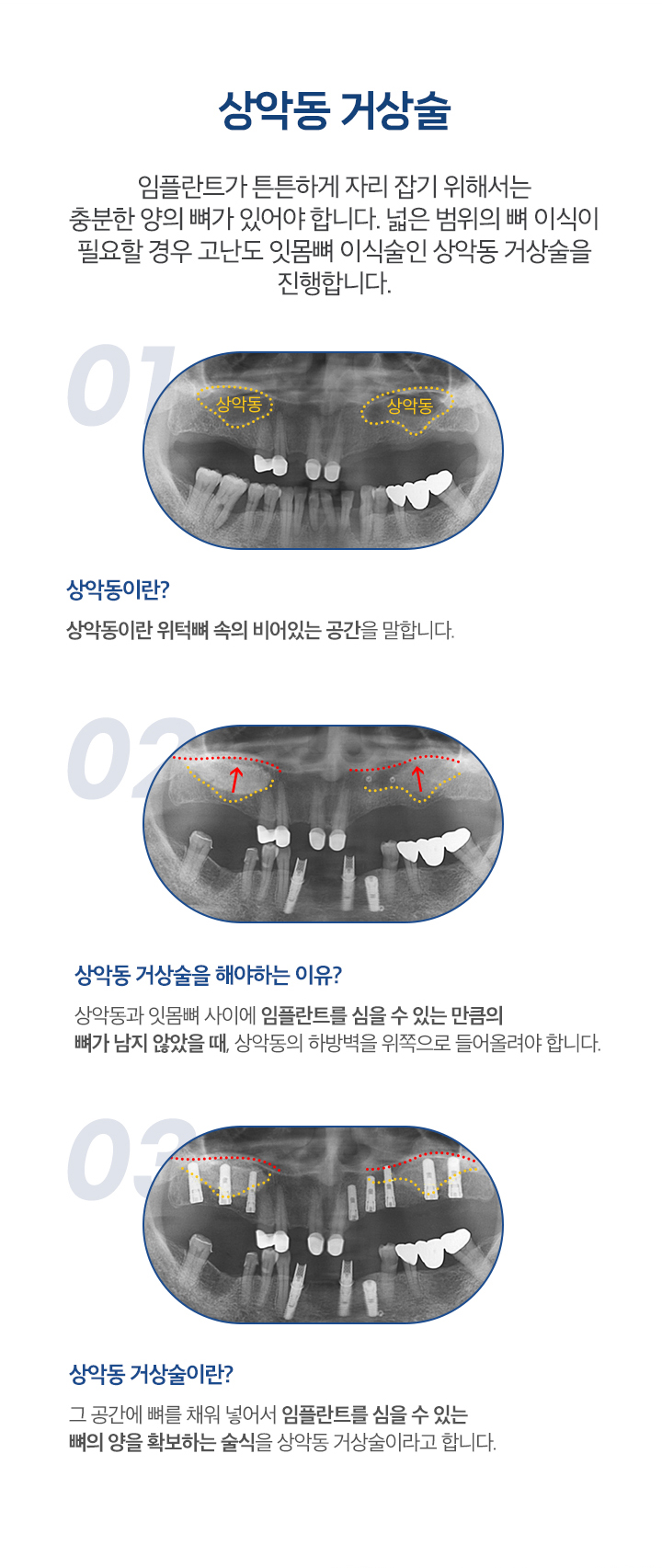 상악동 거상술