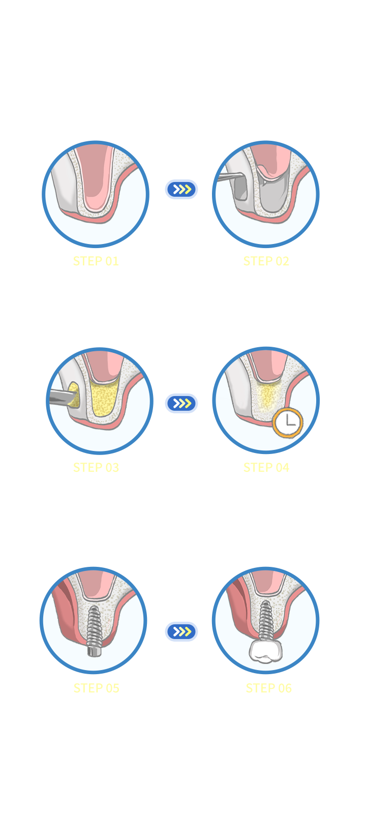 상악동 거상술 시술 과정