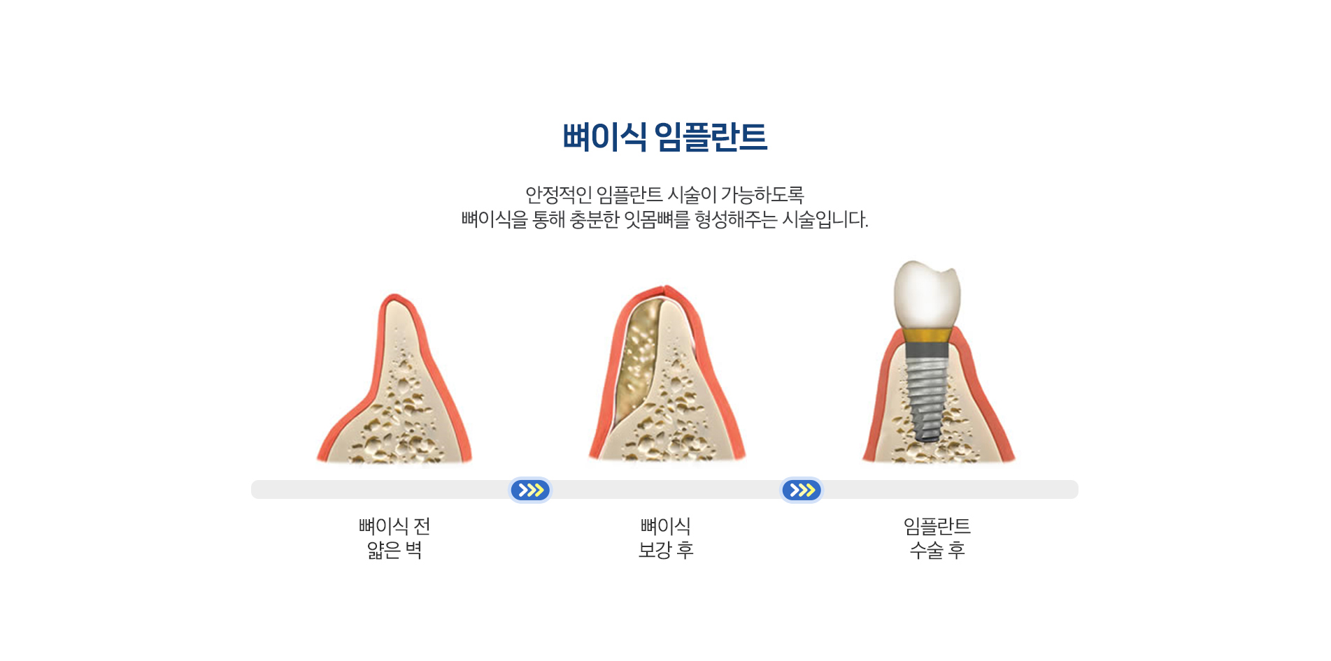 뼈이식 임플란트