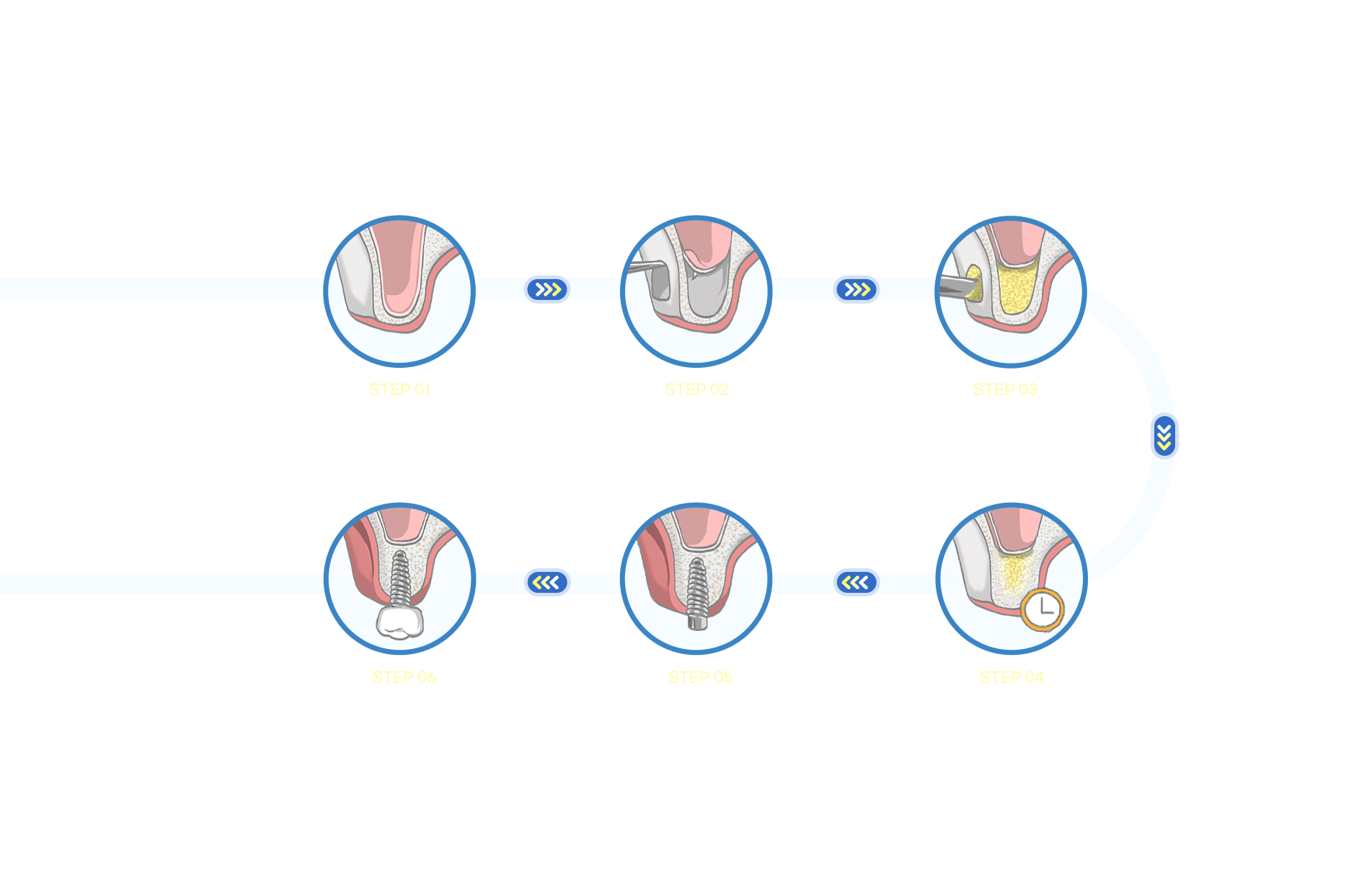 상악동 거상술 시술 과정