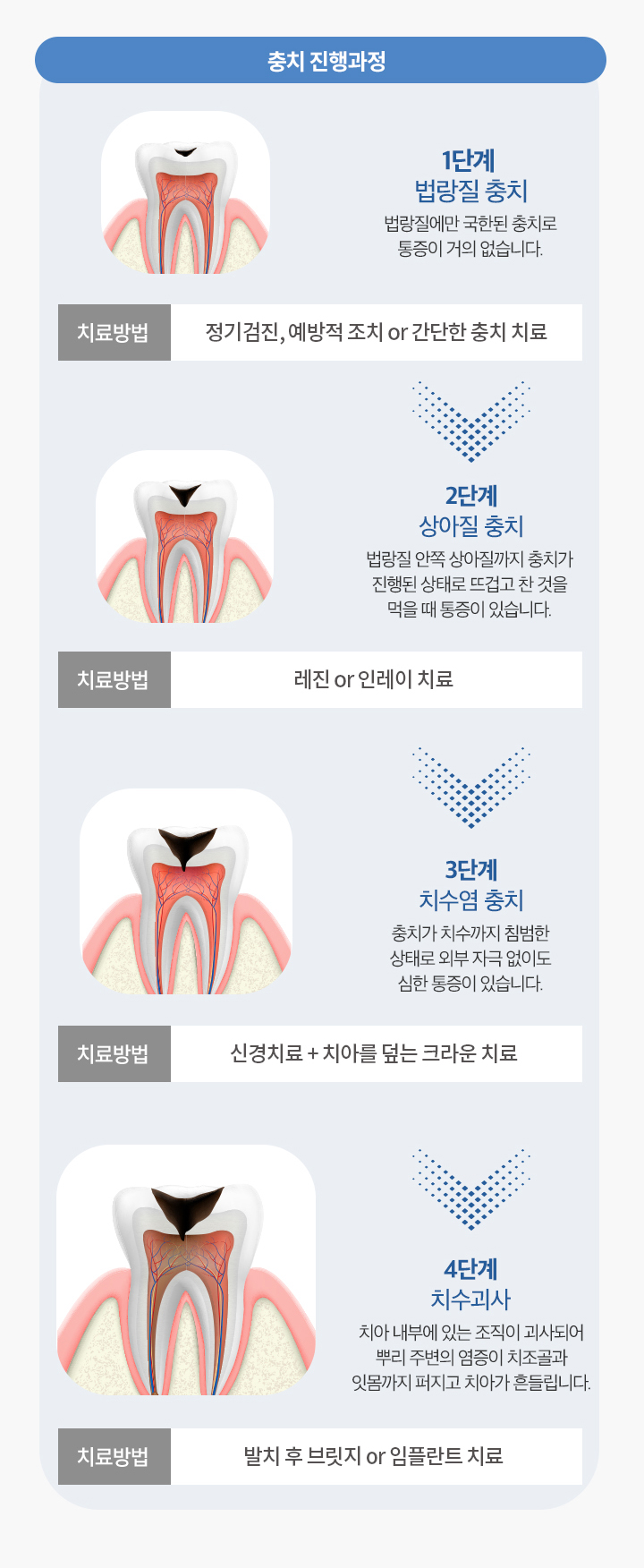 충치 진행과정 / 치료방법