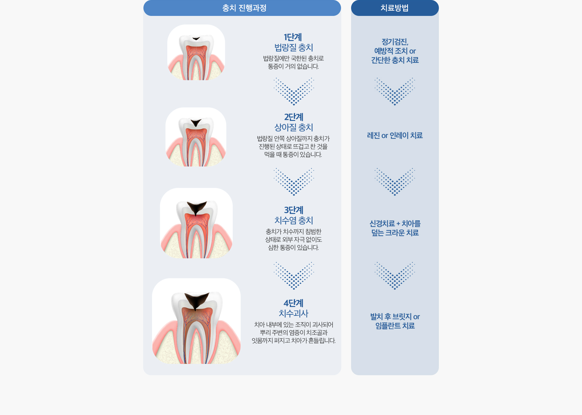 충치 진행과정 / 치료방법