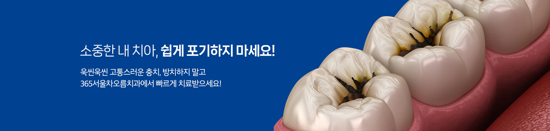 소중한 내 치아, 쉽게 포기하지 마세요!