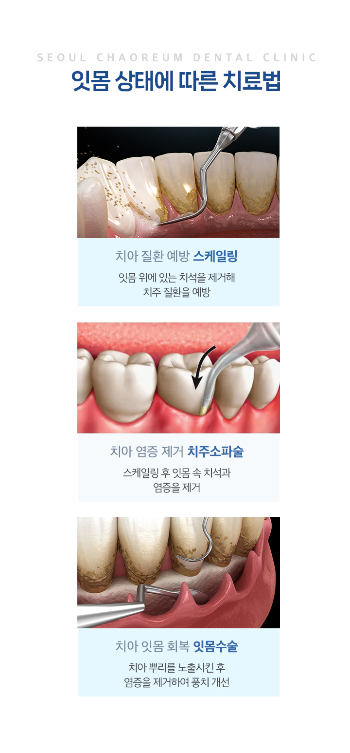 잇몸 상태에 따른 치료법