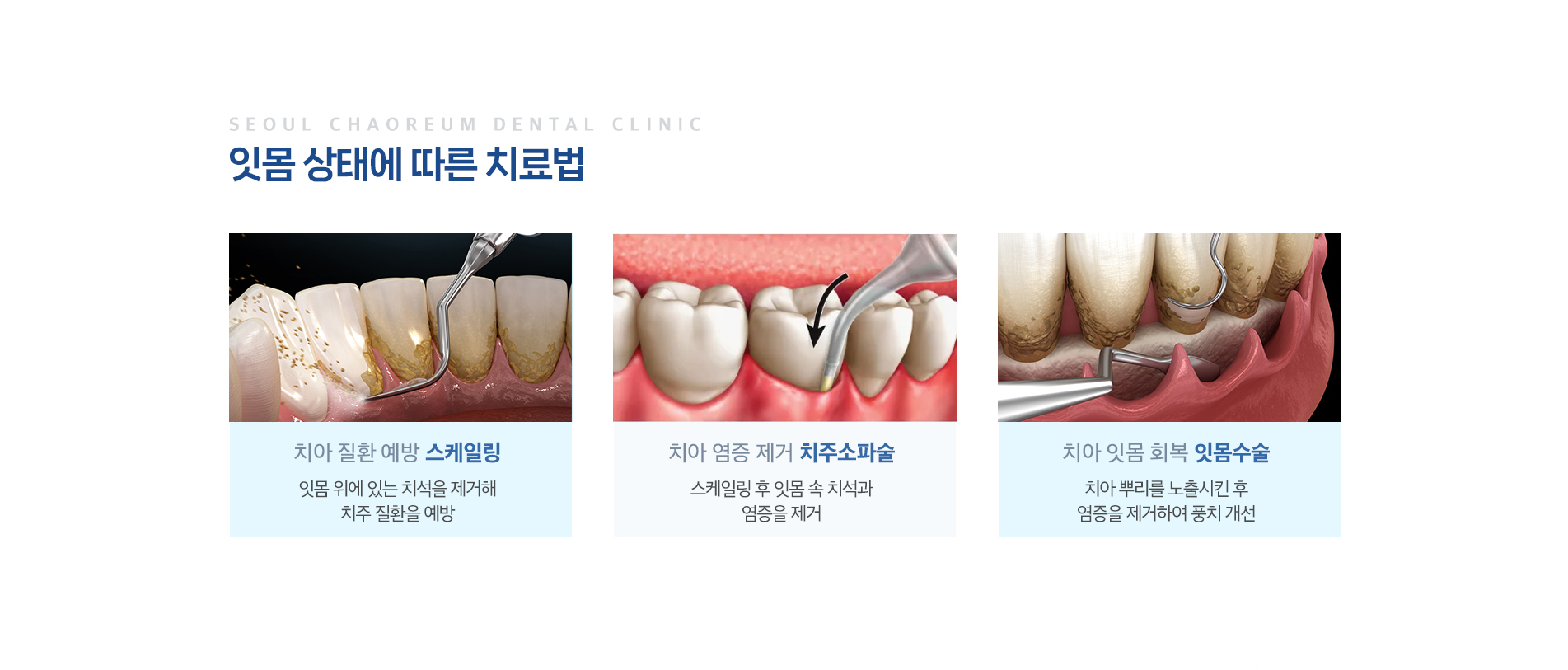 잇몸 상태에 따른 치료법