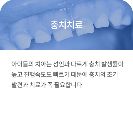 충치치료