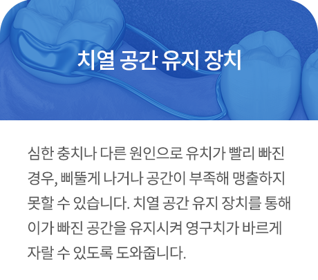 치열 공간 유지 장치