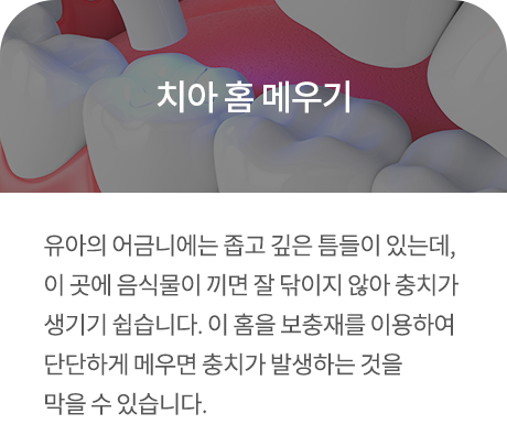 치아 홈 메우기